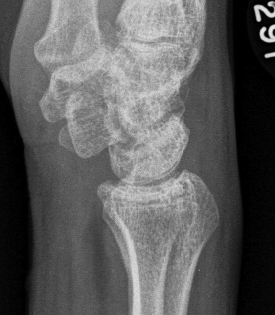 Scaphoid Nonunion Lateral